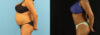 Liposuction case #6014 slider thumbnail