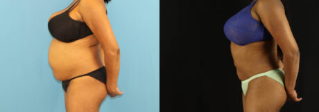 Liposuction case #6014