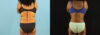 Liposuction case #6014 slider thumbnail