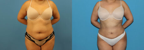 Liposuction case #6010