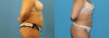 Liposuction case #6010 slider thumbnail