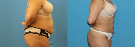 Liposuction case #6010