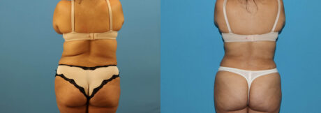 Liposuction case #6010