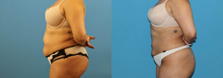 Liposuction case #6010