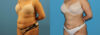 Liposuction case #6010 slider thumbnail
