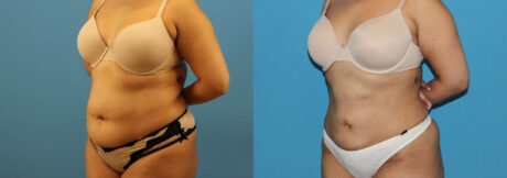 Liposuction case #6010