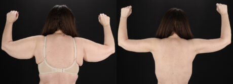 Arm Lift case #4384