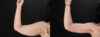 Arm Lift case #4393 slider thumbnail