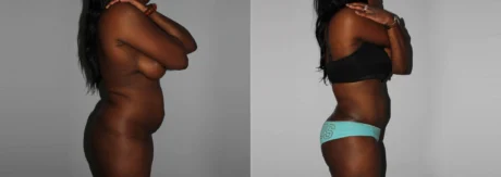 Brazilian Butt Lift case #4471