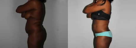 Brazilian Butt Lift case #4471