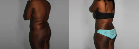 Brazilian Butt Lift case #4471