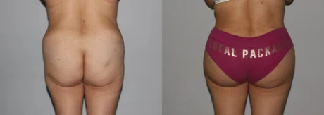 Brazilian Butt Lift case #4725