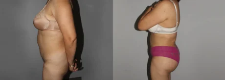 Brazilian Butt Lift case #4725