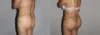 Brazilian Butt Lift case #4725 slider thumbnail
