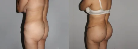 Brazilian Butt Lift case #4725