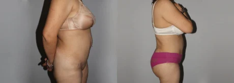 Brazilian Butt Lift case #4725