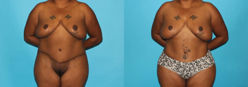 Brazilian Butt Lift case #4513