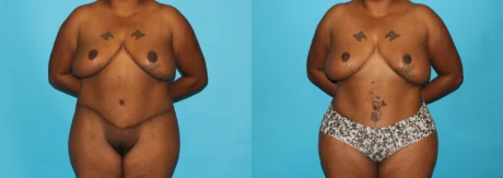 Brazilian Butt Lift case #4513