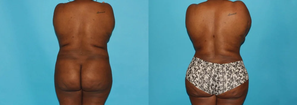 Brazilian Butt Lift case #4513