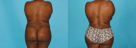 Brazilian Butt Lift case #4513