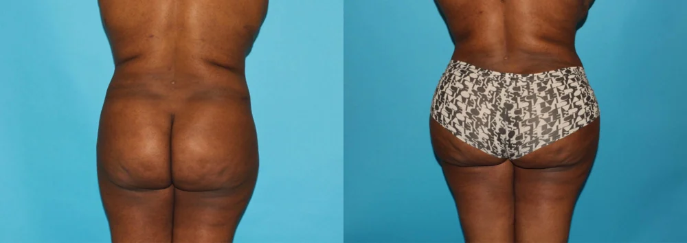 Brazilian Butt Lift case #4513