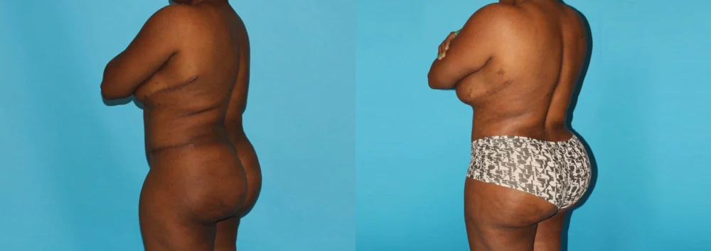 Brazilian Butt Lift case #4513