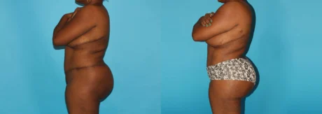 Brazilian Butt Lift case #4513