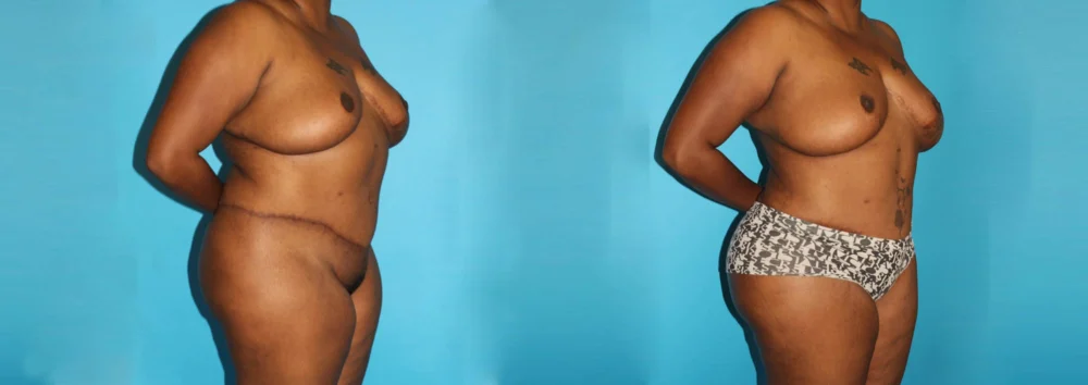 Brazilian Butt Lift case #4513