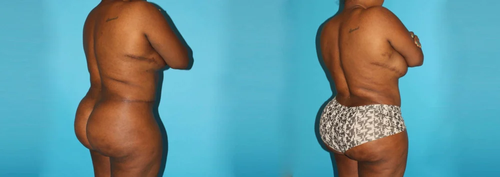 Brazilian Butt Lift case #4513