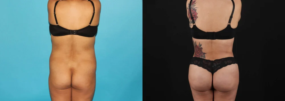 Brazilian Butt Lift case #4537