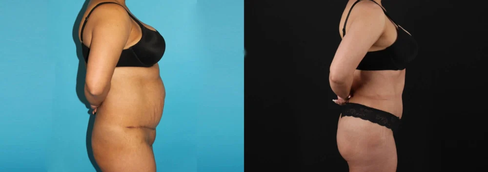 Brazilian Butt Lift case #4537