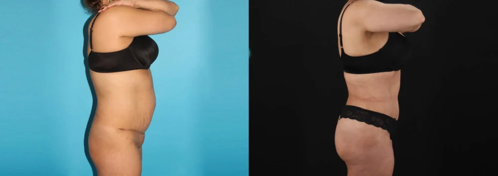 Brazilian Butt Lift case #4537