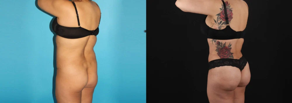 Brazilian Butt Lift case #4537