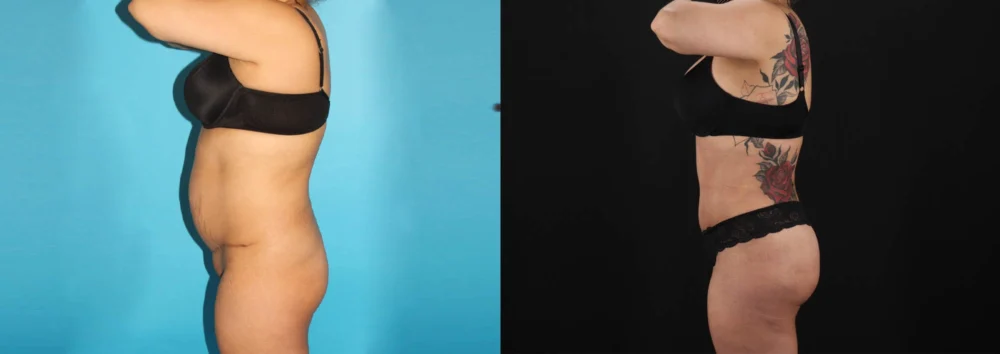 Brazilian Butt Lift case #4537