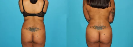 Brazilian Butt Lift case #4764