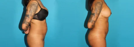 Brazilian Butt Lift case #4764