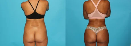 Brazilian Butt Lift case #4765