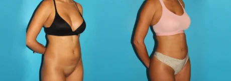 Brazilian Butt Lift case #4765