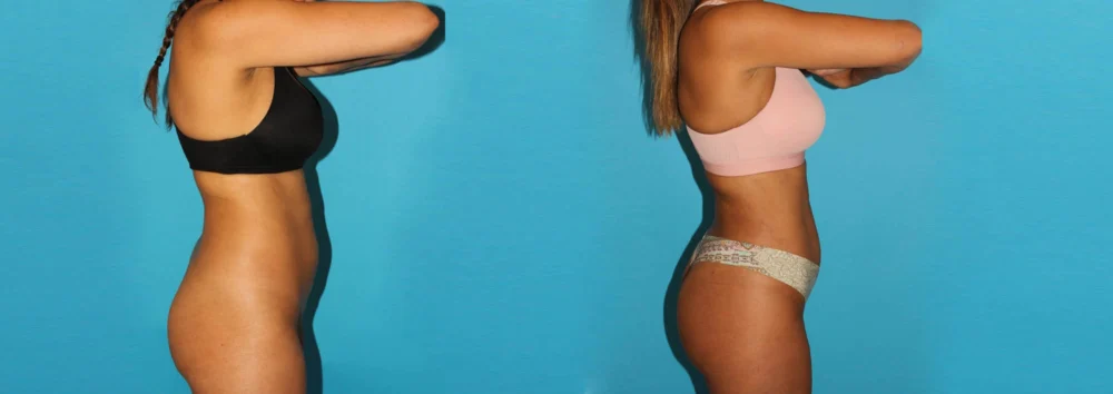 Brazilian Butt Lift case #4765