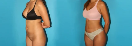 Brazilian Butt Lift case #4765