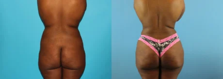 Brazilian Butt Lift case #4583