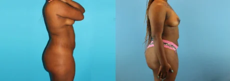 Brazilian Butt Lift case #4583