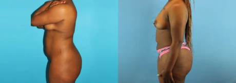 Brazilian Butt Lift case #4583