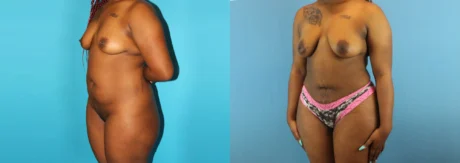 Brazilian Butt Lift case #4583