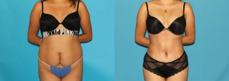 Brazilian Butt Lift case #4819