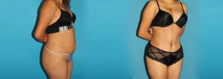 Brazilian Butt Lift case #4819