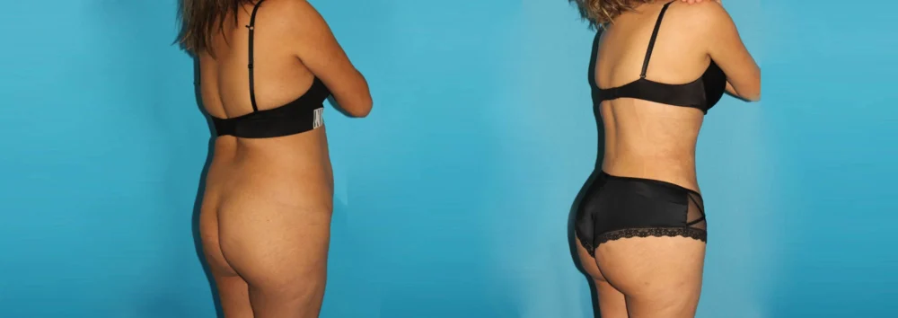 Brazilian Butt Lift case #4819