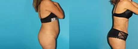 Brazilian Butt Lift case #4819