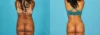 Brazilian Butt Lift case #4675 slider thumbnail