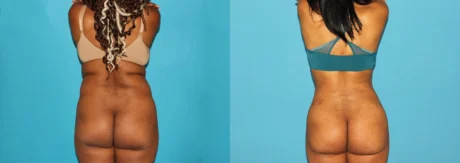 Brazilian Butt Lift case #4675